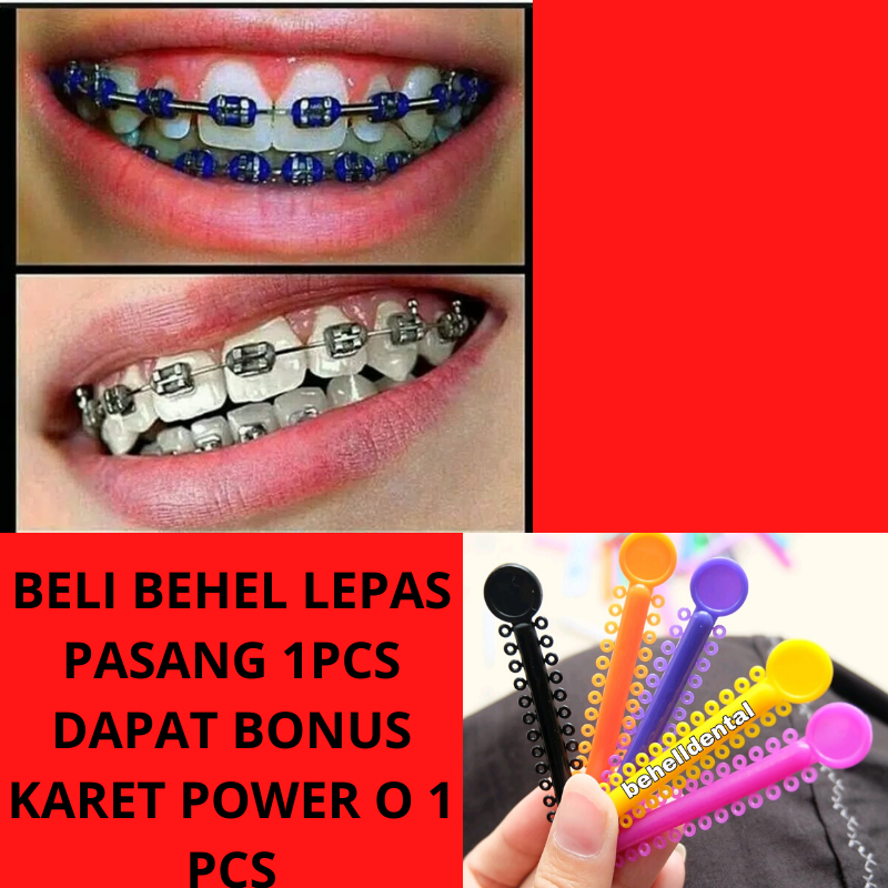 Detail Gambar Behel Lepas Pasang Nomer 11