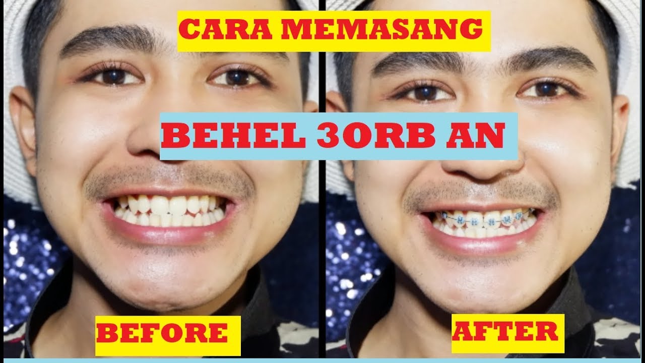 Detail Gambar Behel Lepas Pasang Nomer 14