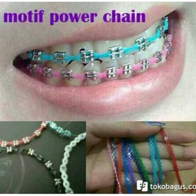 Detail Gambar Behel Lepas Pasang Nomer 17