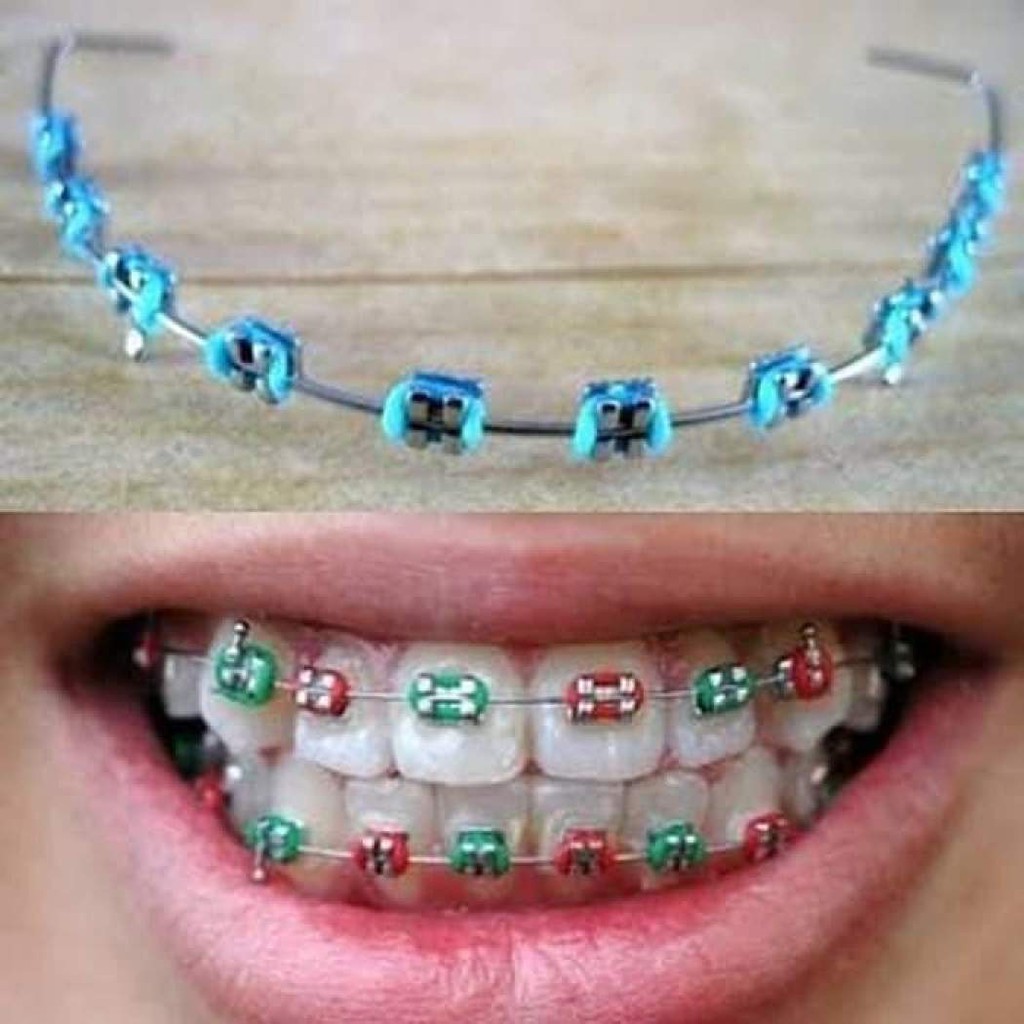 Detail Gambar Behel Lepas Pasang Nomer 3