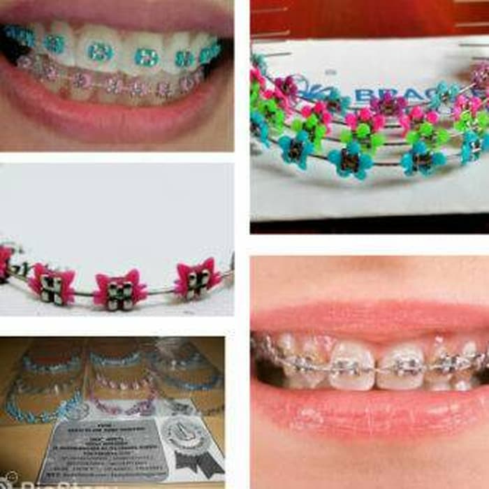 Detail Gambar Behel Lepas Pasang Nomer 23