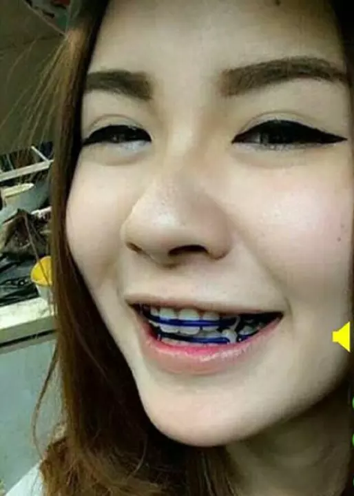 Detail Gambar Behel Lepas Pasang Nomer 25