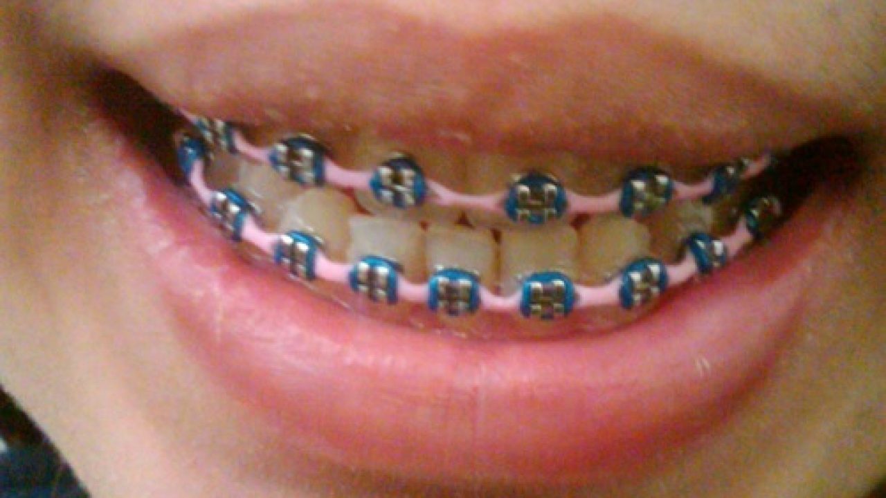 Detail Gambar Behel Lepas Pasang Nomer 27