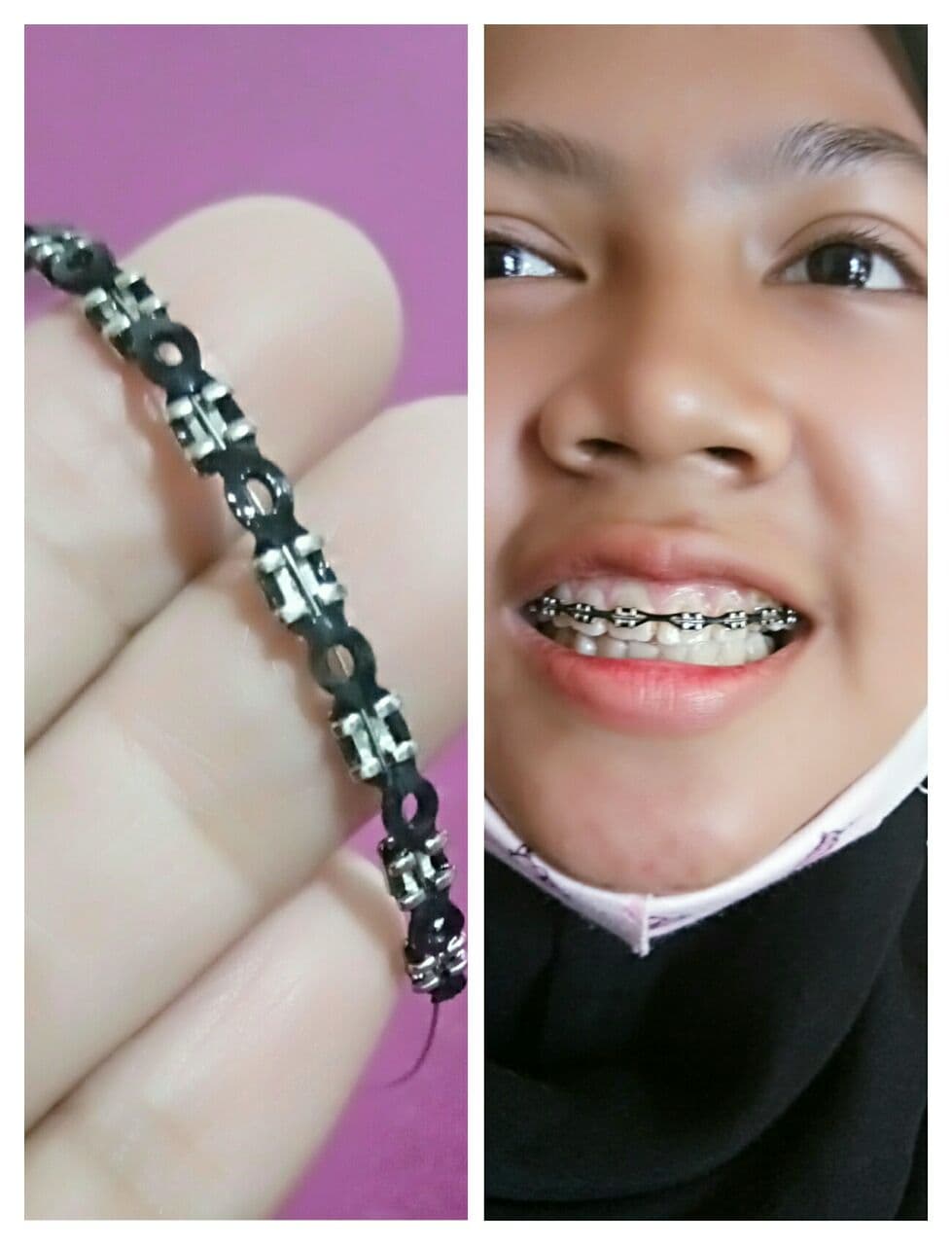 Detail Gambar Behel Lepas Pasang Nomer 4
