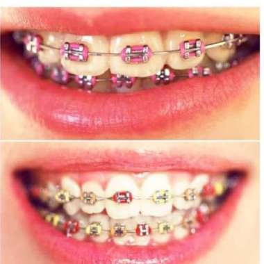 Detail Gambar Behel Lepas Pasang Nomer 33