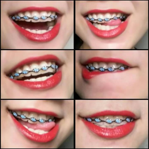 Detail Gambar Behel Lepas Pasang Nomer 34