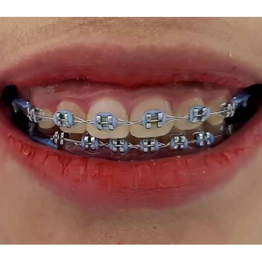 Detail Gambar Behel Lepas Pasang Nomer 37