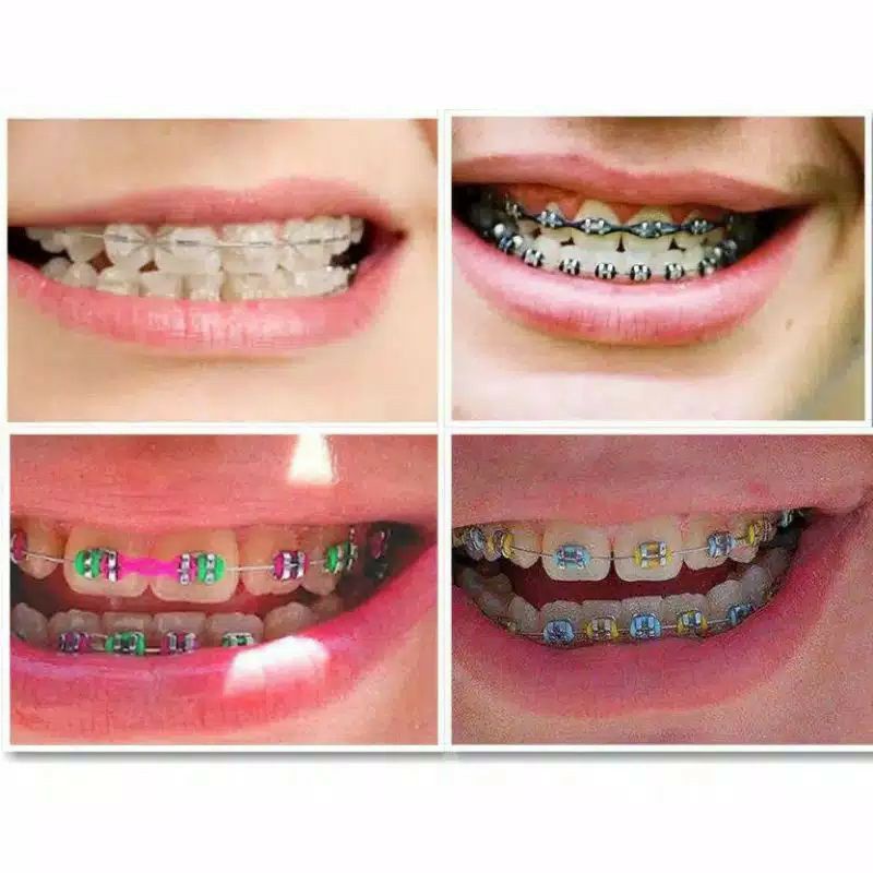Detail Gambar Behel Lepas Pasang Nomer 45