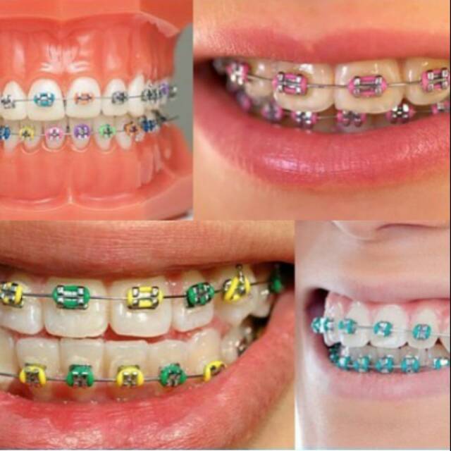 Detail Gambar Behel Lepas Pasang Nomer 46