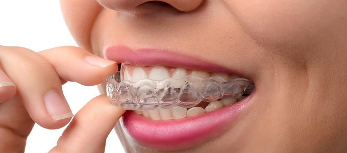 Detail Gambar Behel Lepas Pasang Nomer 47