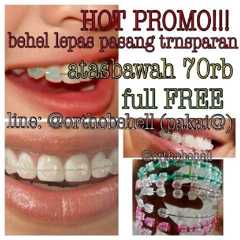 Detail Gambar Behel Lepas Pasang Nomer 51