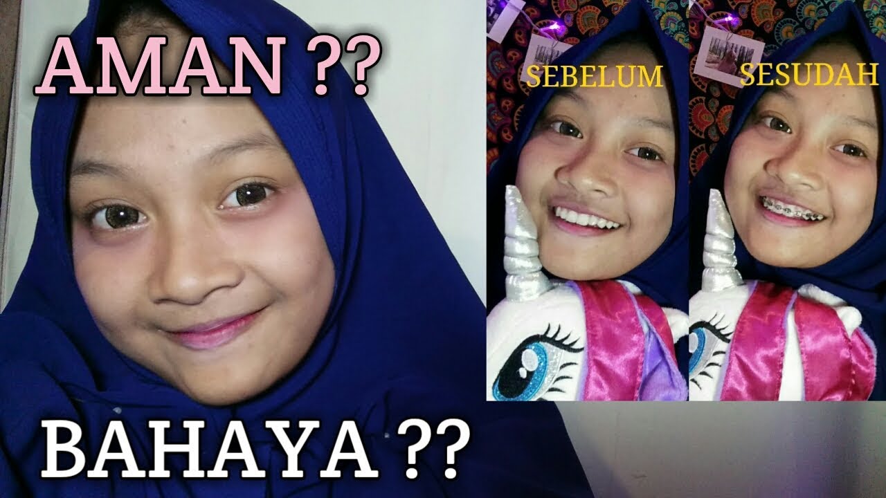 Detail Gambar Behel Lepas Pasang Nomer 52