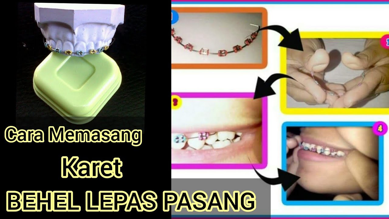 Detail Gambar Behel Lepas Pasang Nomer 55