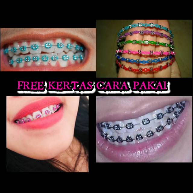 Detail Gambar Behel Lepas Pasang Nomer 57