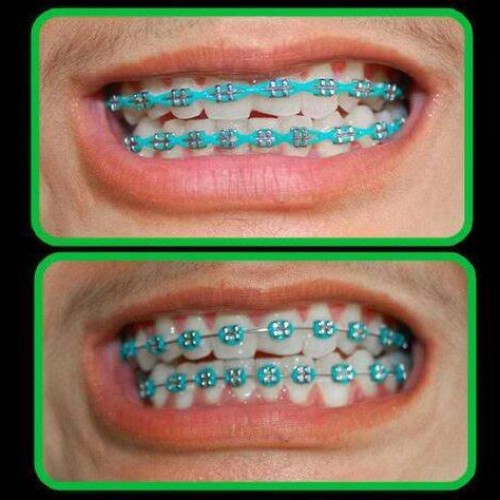 Detail Gambar Behel Lepas Pasang Nomer 7