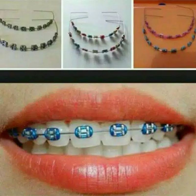 Detail Gambar Behel Lepas Pasang Nomer 9