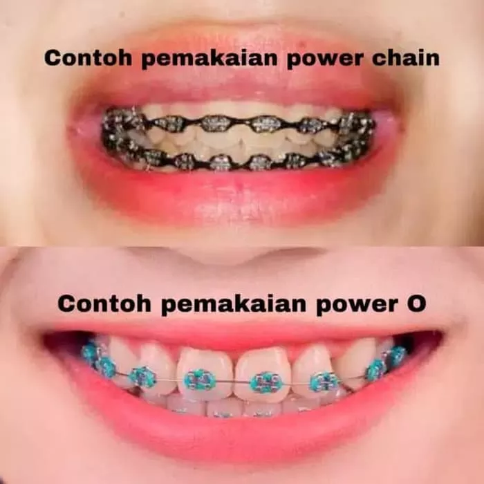 Detail Gambar Behel Power Chain Nomer 2