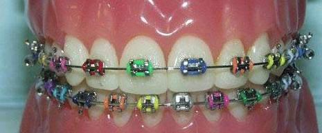 Detail Gambar Behel Warna Warni Nomer 14