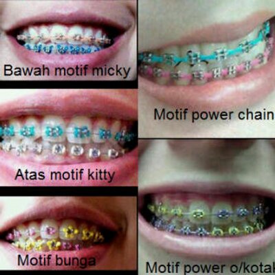 Detail Gambar Behel Warna Warni Nomer 3