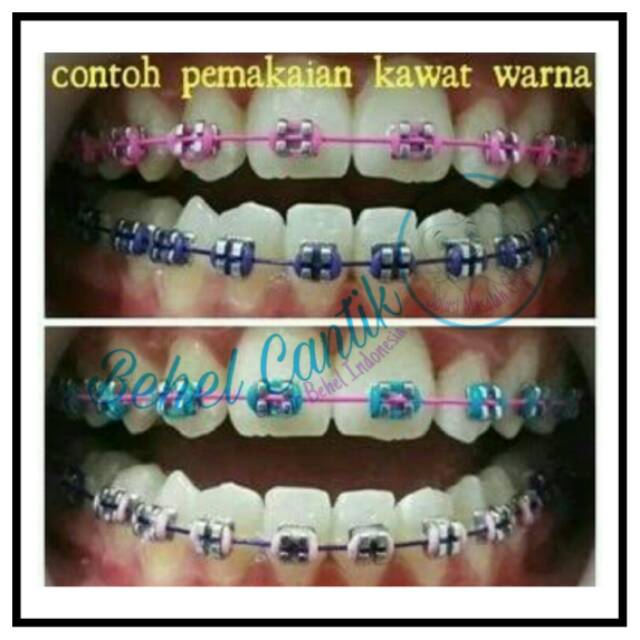 Detail Gambar Behel Warna Warni Nomer 27