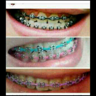 Detail Gambar Behel Warna Warni Nomer 50