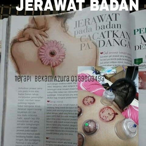 Detail Gambar Bekam Badan Nomer 30