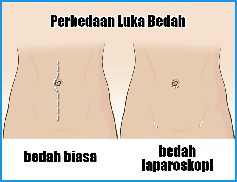 Detail Gambar Bekas Operasi Kista Nomer 17