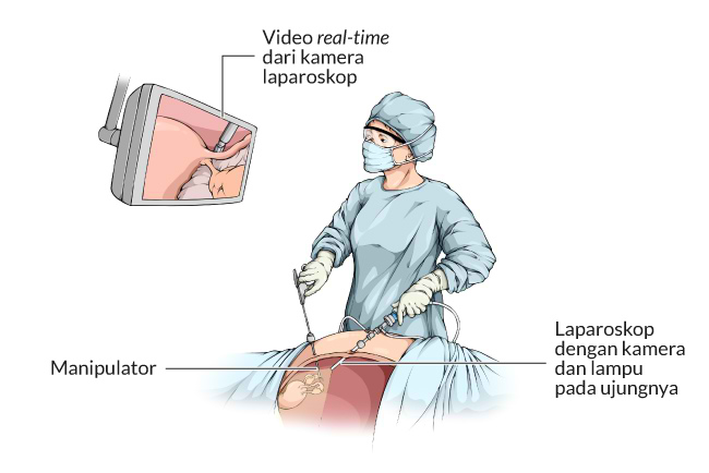 Detail Gambar Bekas Operasi Kista Nomer 50