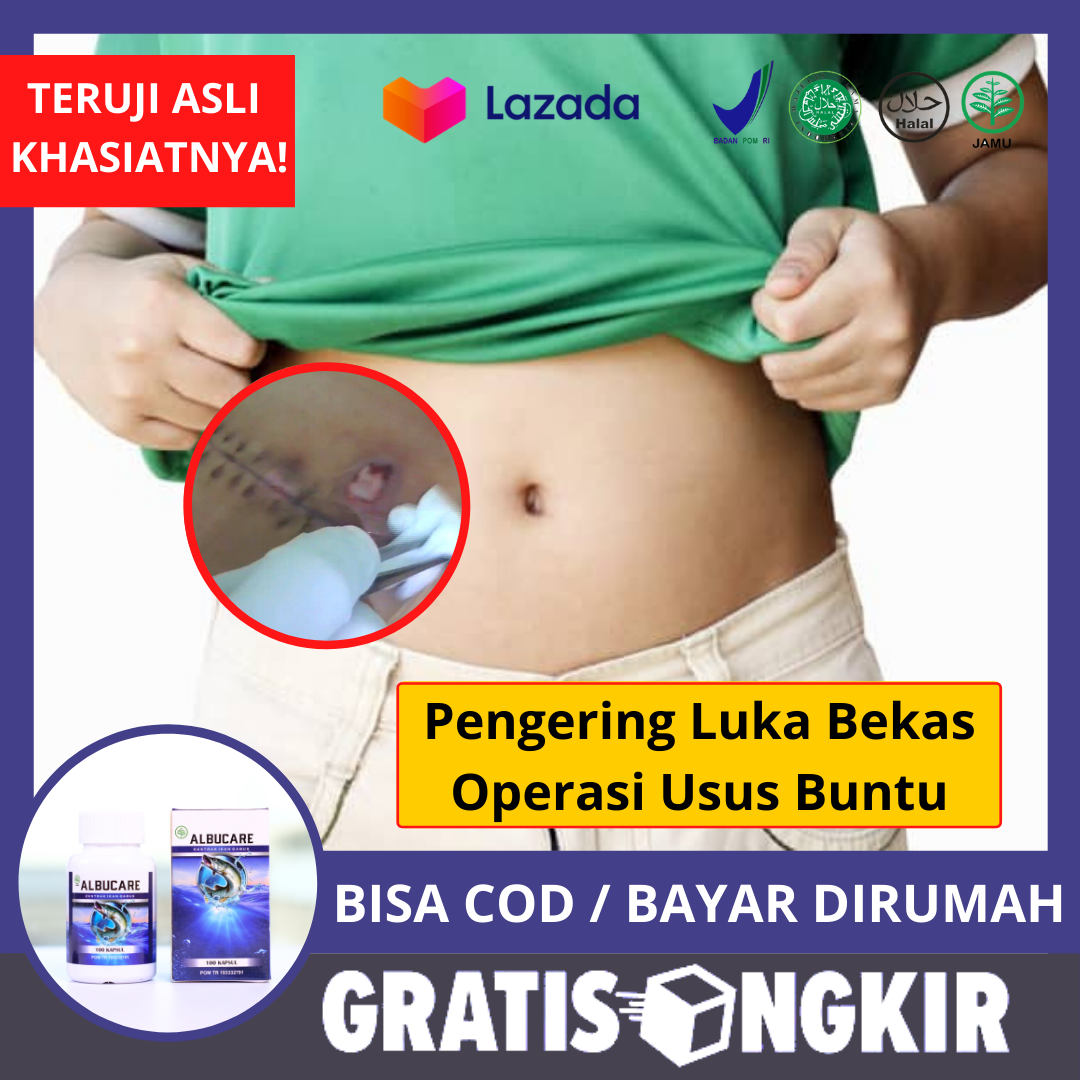 Detail Gambar Bekas Operasi Usus Buntu Nomer 12