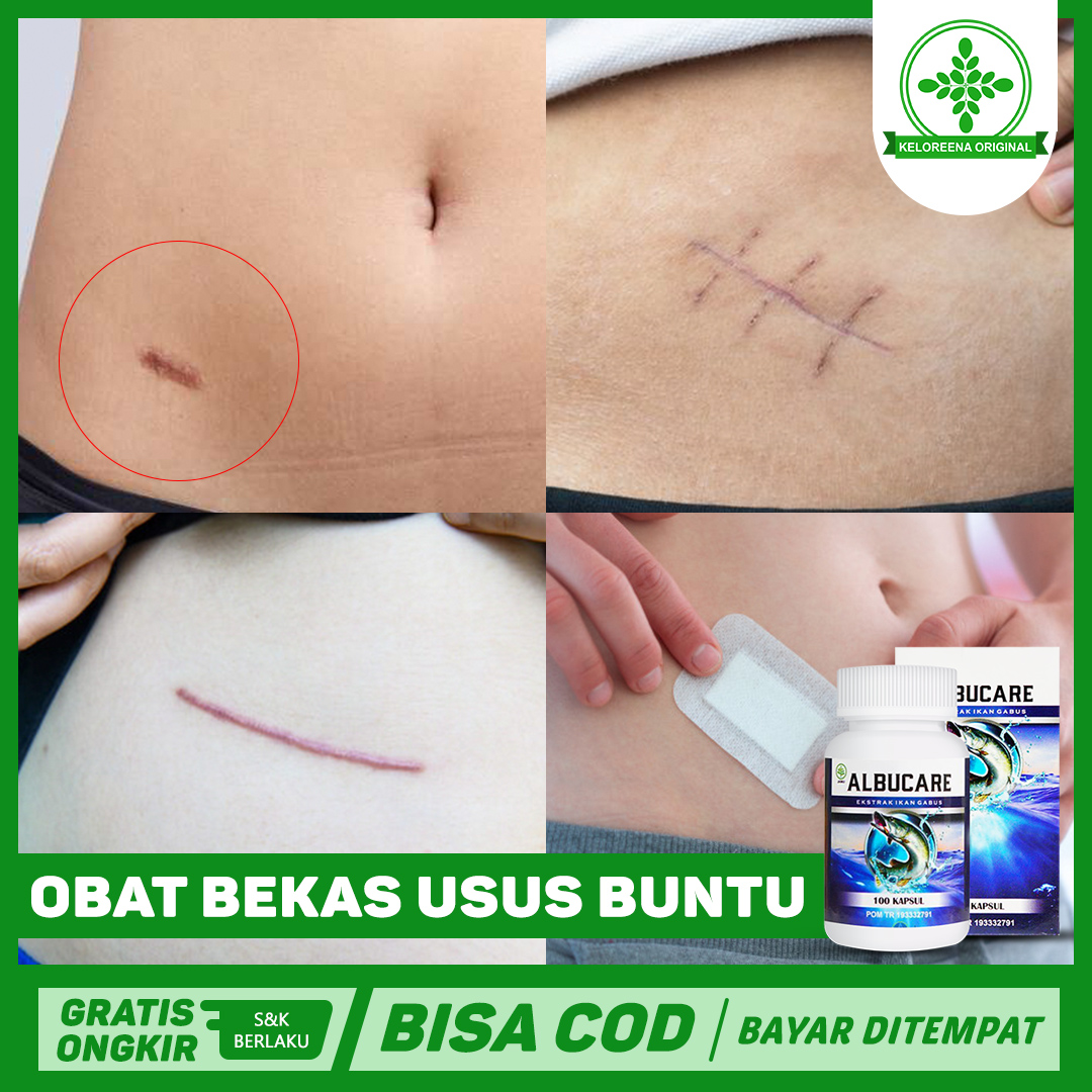 Detail Gambar Bekas Operasi Usus Buntu Nomer 36