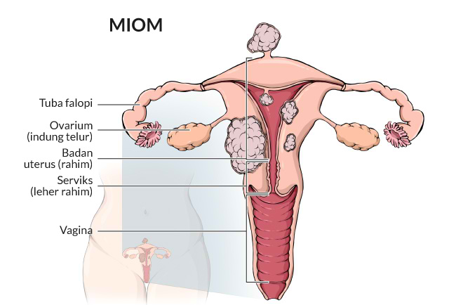 Detail Gambar Benjolan Di Leher Rahim Nomer 35