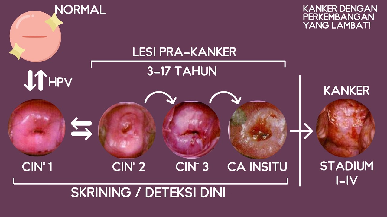 Detail Gambar Benjolan Di Leher Rahim Nomer 4