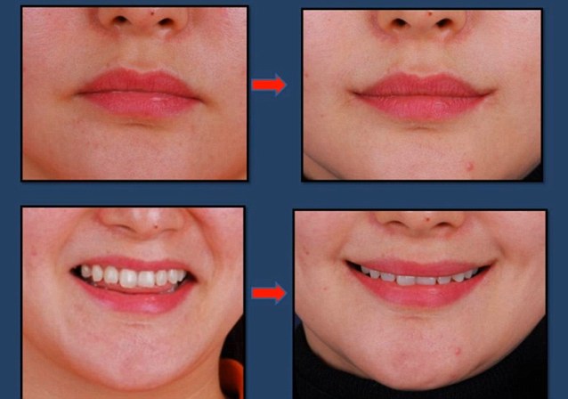 Detail Gambar Bibir Senyum Nomer 22