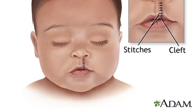 Detail Gambar Bibir Sumbing Nomer 16