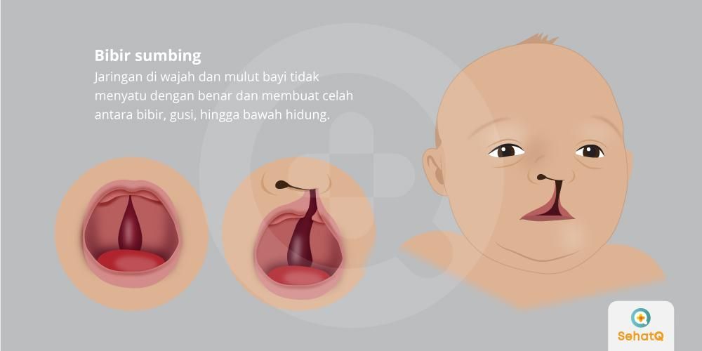 Detail Gambar Bibir Sumbing Nomer 7