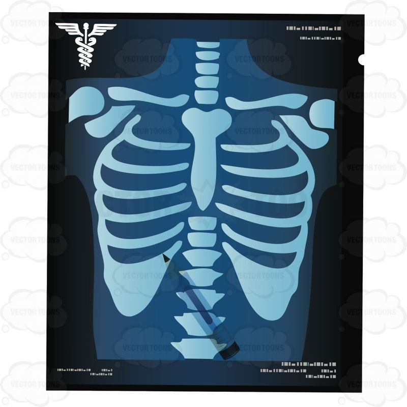 Detail Chest X Ray Clipart Nomer 11