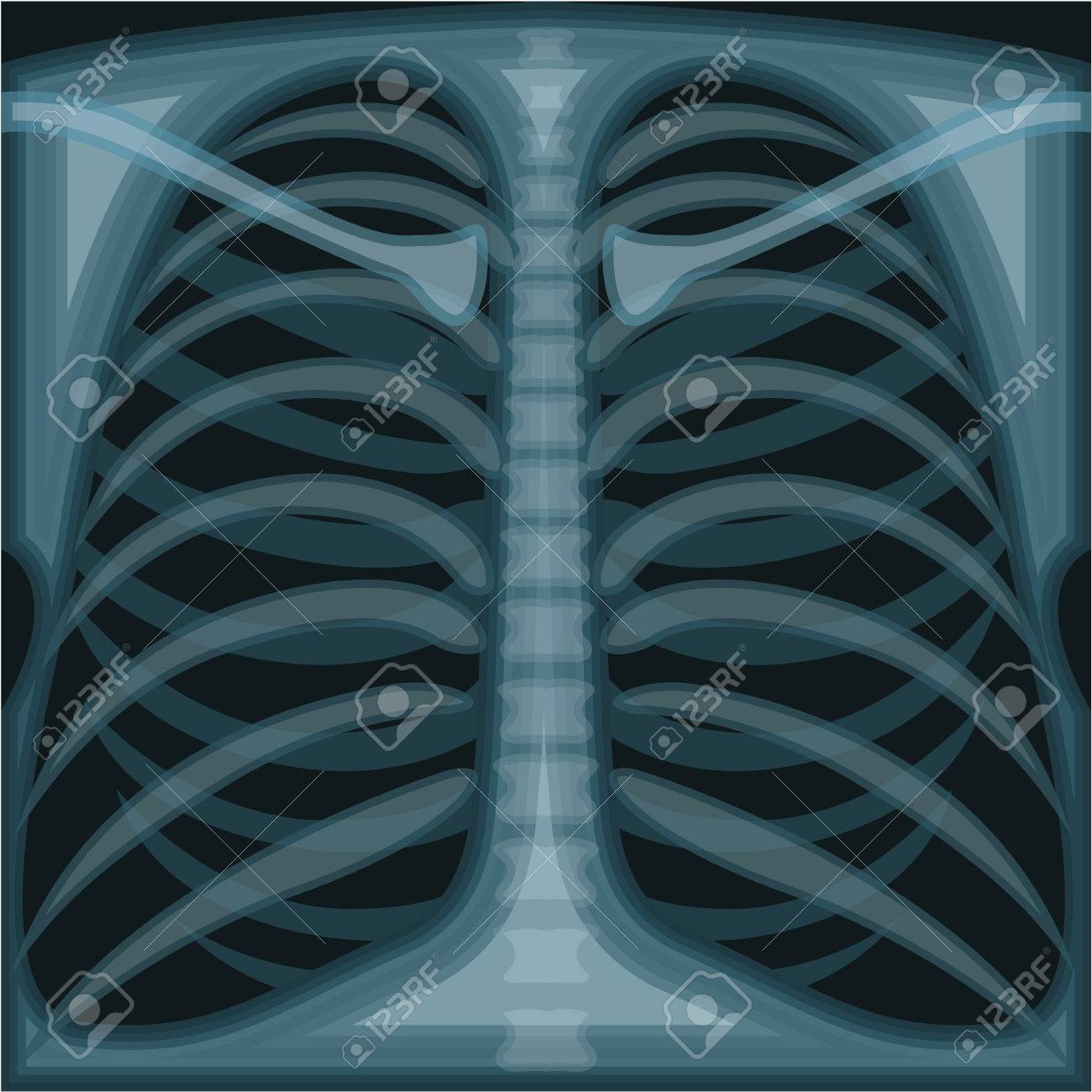 Detail Chest X Ray Clipart Nomer 18