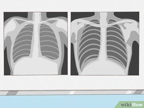 Detail Chest X Ray Clipart Nomer 47