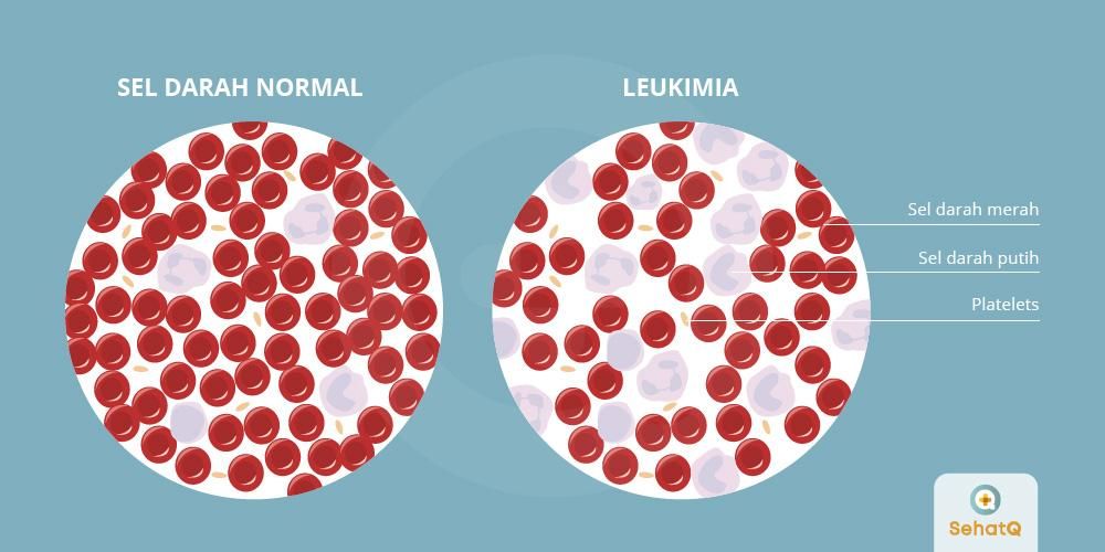 Detail Gambar Bintik Merah Pada Penderita Leukemia Nomer 32