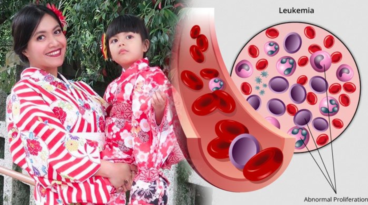 Detail Gambar Bintik Merah Pada Penderita Leukemia Nomer 40