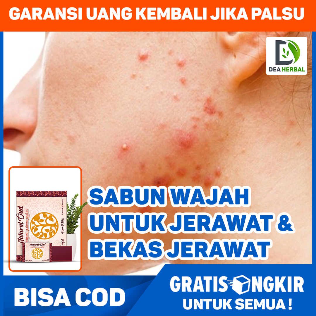 Detail Gambar Bioplacenton Untuk Jerawat Nomer 55