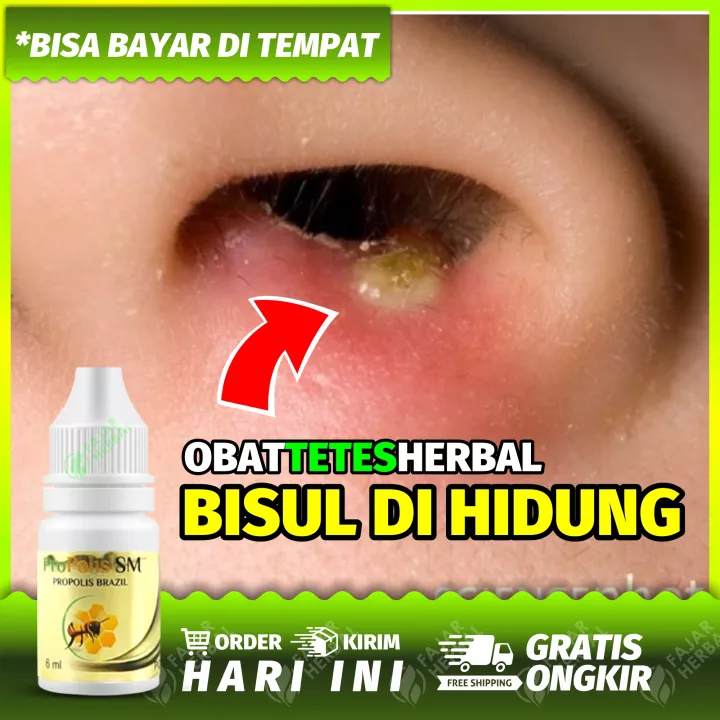 Detail Gambar Bisul Di Dalam Telinga Nomer 42