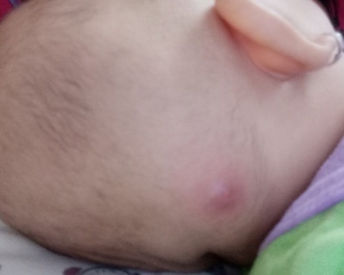 Detail Gambar Bisul Di Kepala Bayi Nomer 54
