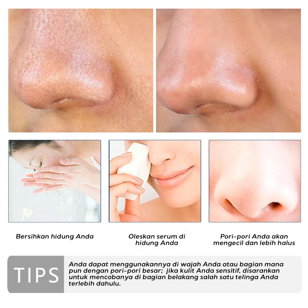 Detail Gambar Bruntusan Di Hidung Nomer 20