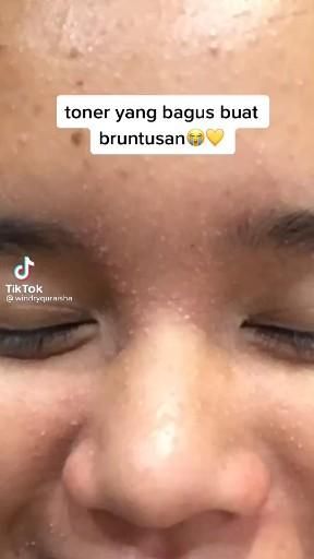 Detail Gambar Bruntusan Di Hidung Nomer 22