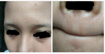 Detail Gambar Bruntusan Di Hidung Nomer 29