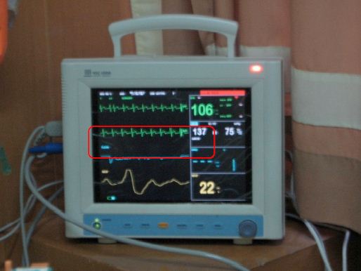 Detail Alat Pendeteksi Detak Jantung Di Rumah Sakit Nomer 27