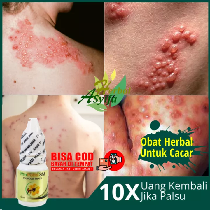 Detail Gambar Cacar Ular Nomer 24