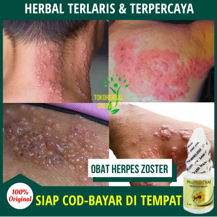 Detail Gambar Cacar Ular Nomer 57