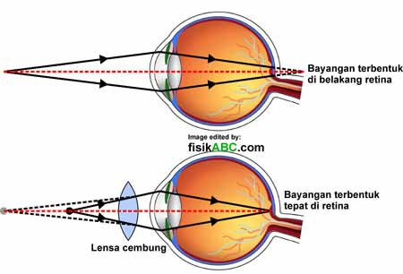 Detail Gambar Cacat Mata Nomer 2